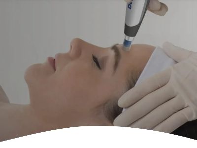 How the Vivace RF Red Cartridge Delivers Targeted Skin Solutions