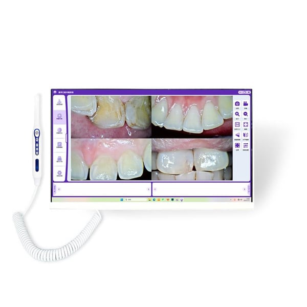 Visualisez votre chemin vers une meilleure santé dentaire avec une caméra pour dents