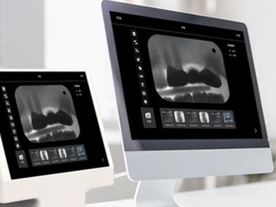 ¿Qué hace que un escáner dental intraoral sea de alto rendimiento?