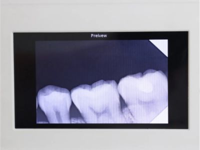 Cámara inalámbrica de radiografía dental: Mejorando la movilidad clínica