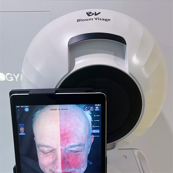 Taking a Closer Look with Skin Analysis for Facials