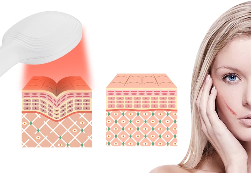 Red light activates hair follicle regeneration promotes Portable Multifunctional Hair Growth Comb supplier