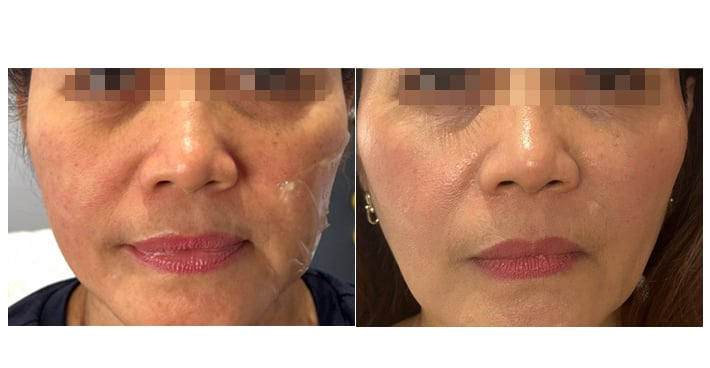 HIFU ta' Terminal Age: Qabel u Wara l-Irrejuveniment tal-Ġilda