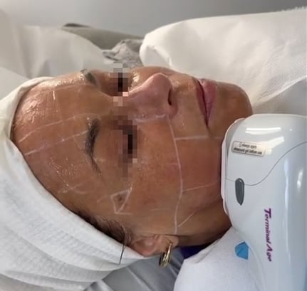 Terminal yaş HIFU ilə SMAS qatının qaldırılması – klinik tətbiq