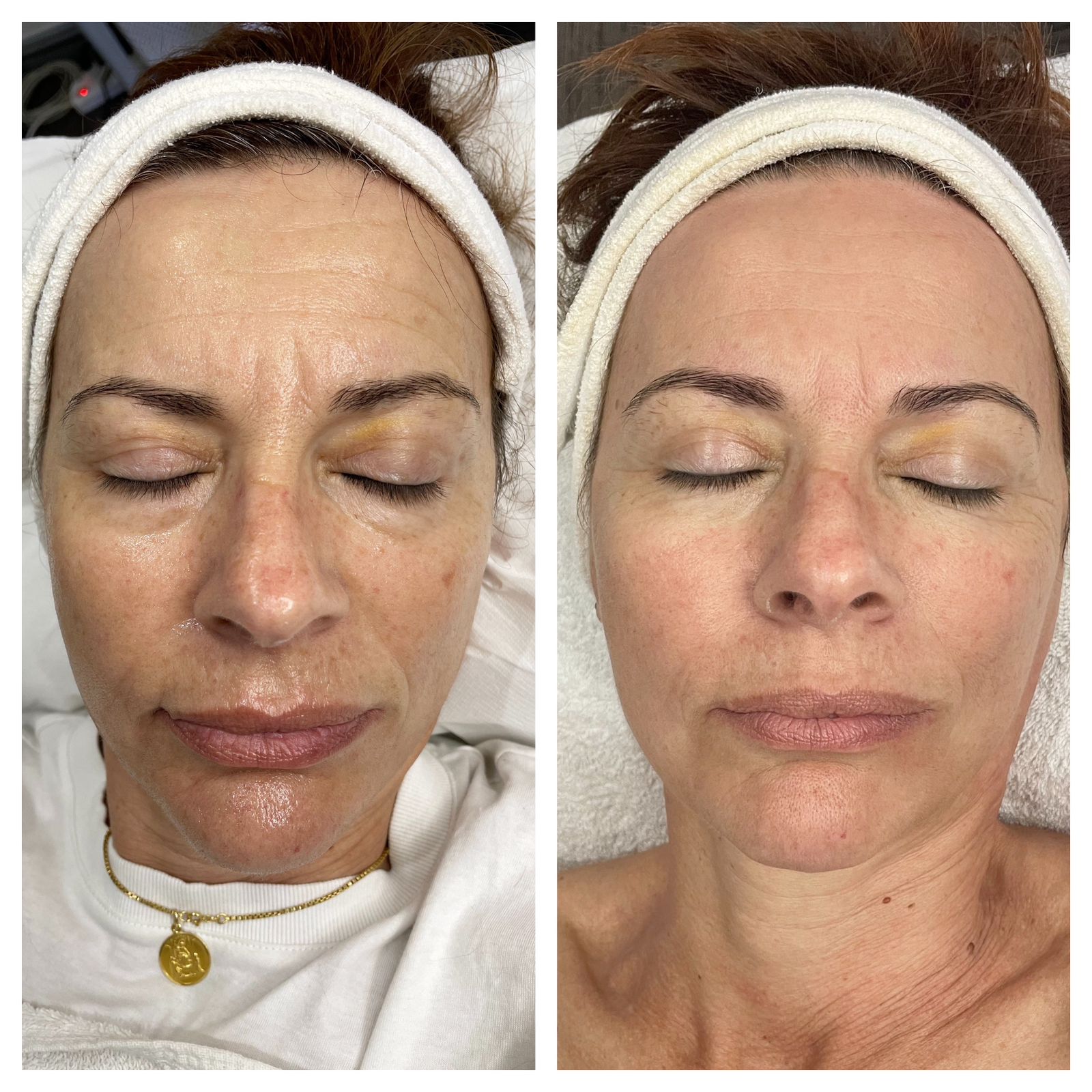 dedicated to stretch marks, pigmentation changes, skin resurfacing