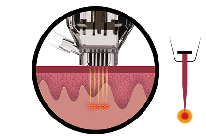 Insulated Needle Technology
