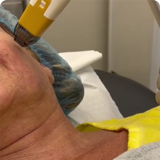 rf microneedle fractional machine shotwalker-15