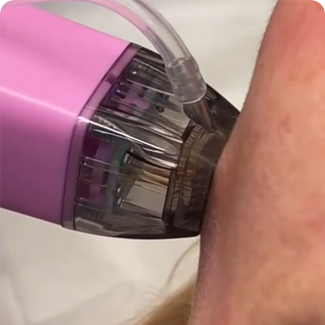 rf microneedle fractional machine shotwalker-13