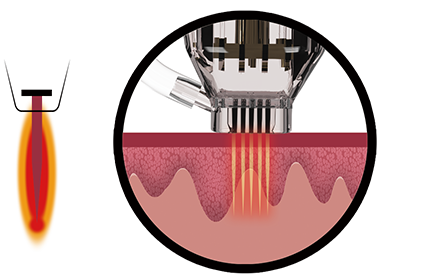 Non-Insulated Needle Technology