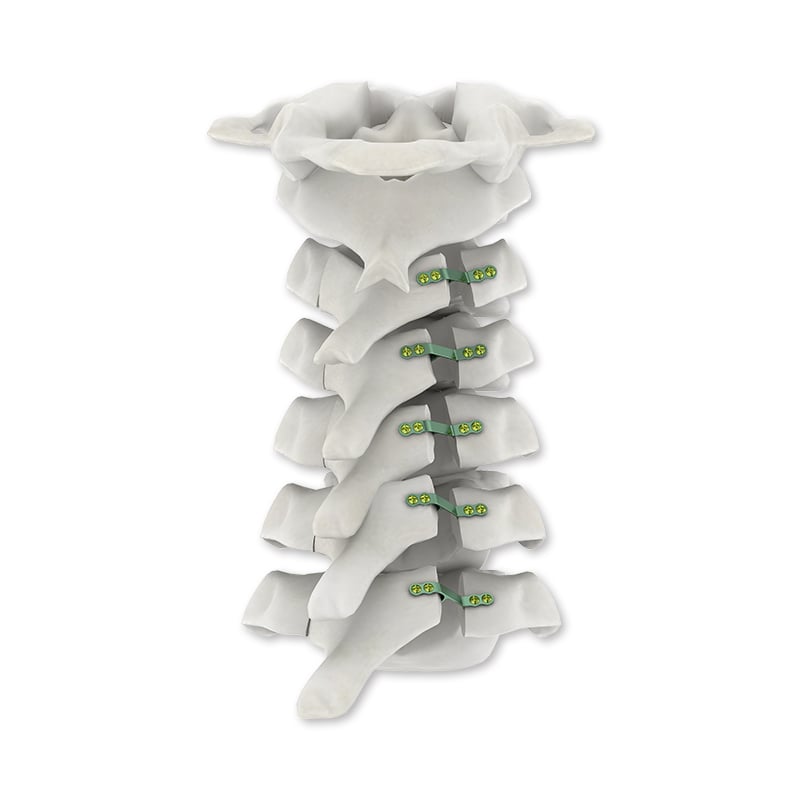 Advanced Thread Design for Superior Bone Purchase