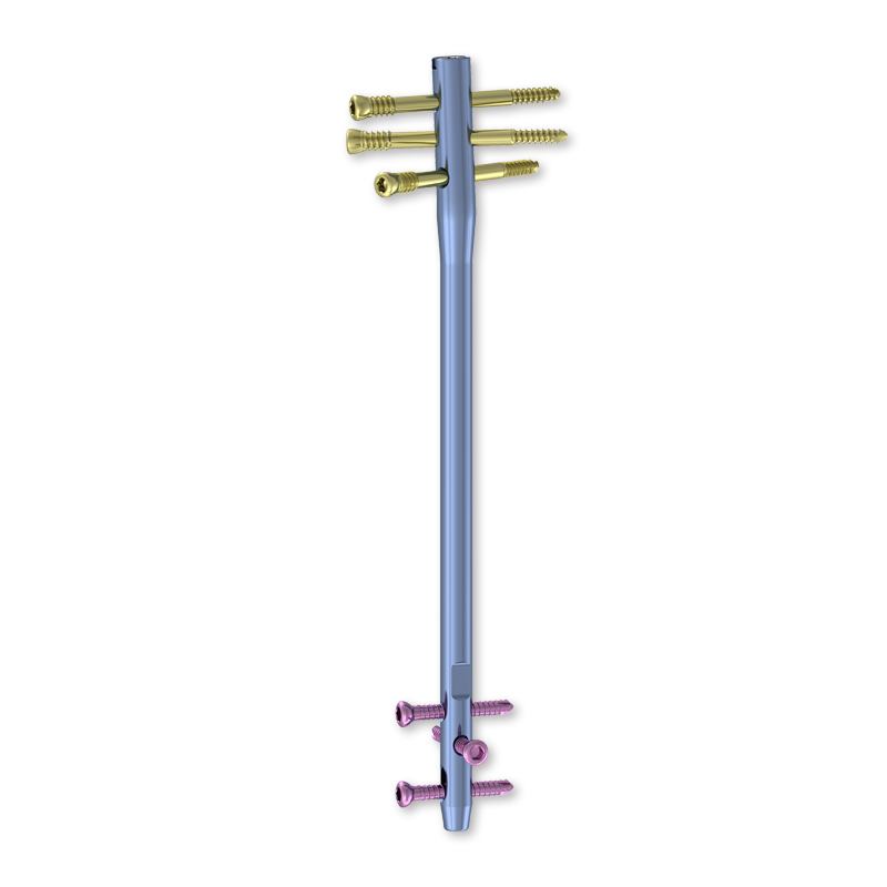 Why Are Interlocking Nails Effective in Long Bone Fractures?