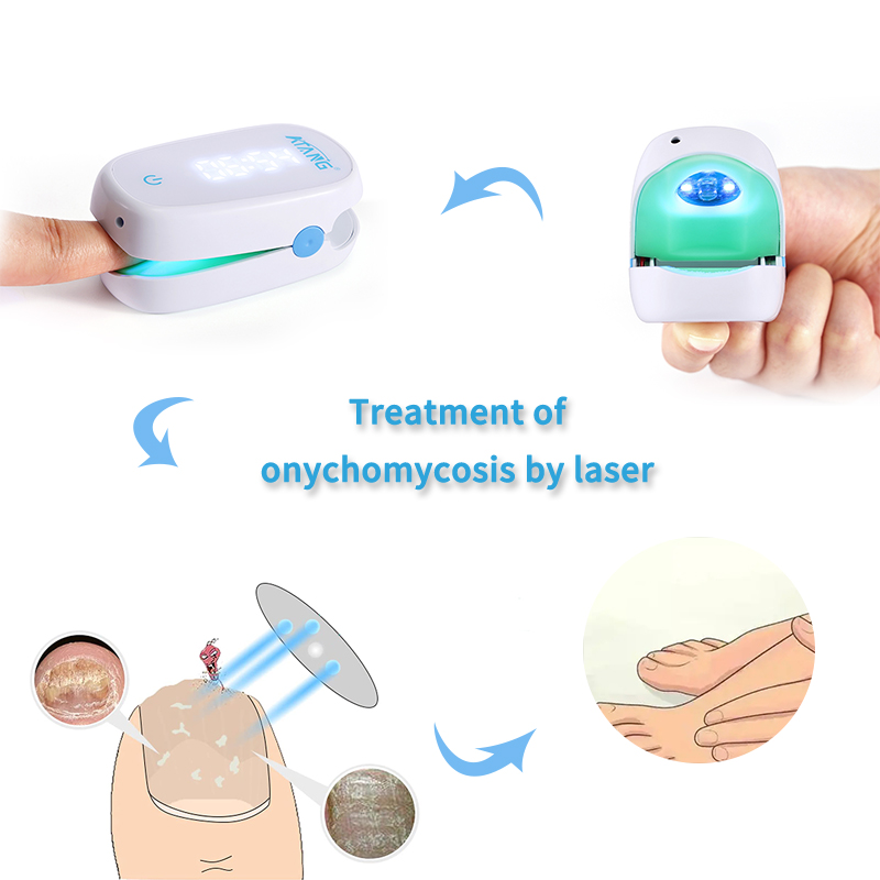 Cure Nail Infections Fast with Infrared Light Combined with Blue Light for Toenail Fungus