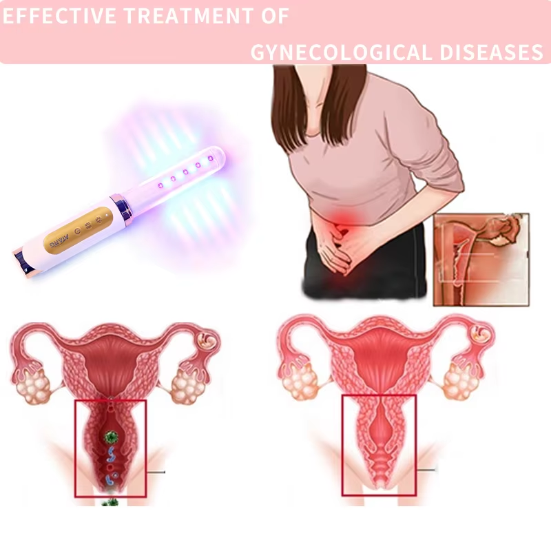 How to Manage Abnormal Vaginal Discharge Properly?
