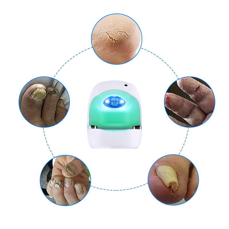 Cure Nail Infections Fast with Infrared Light Combined with Blue Light for Toenail Fungus