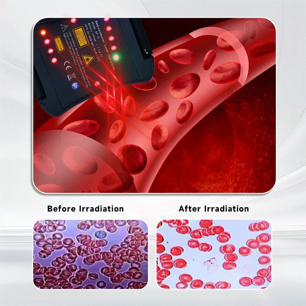 High Blood Pressure & Diabetes Support Home LLLT Laser Watch for Arterial Health