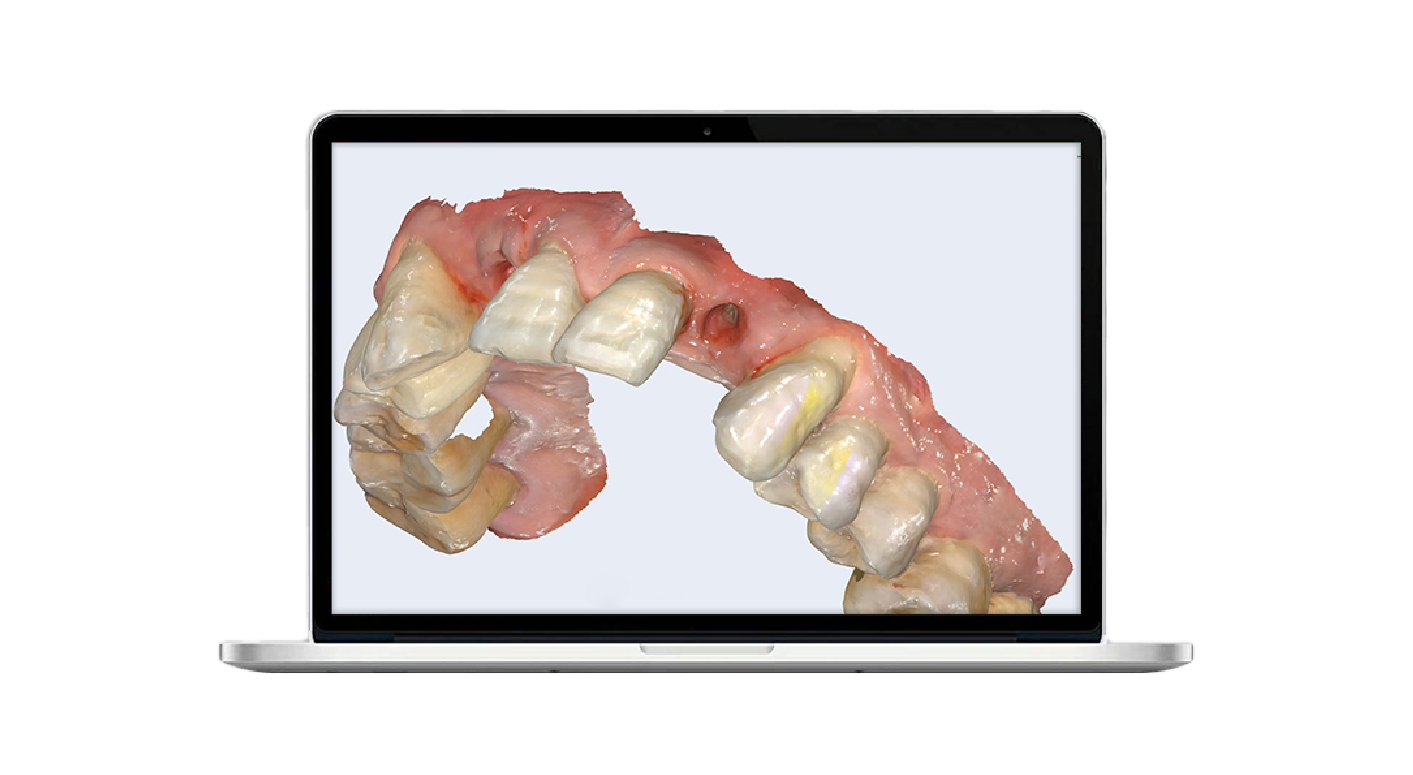 4d x ml the ideal restoration choice in the digital dentistry era-1