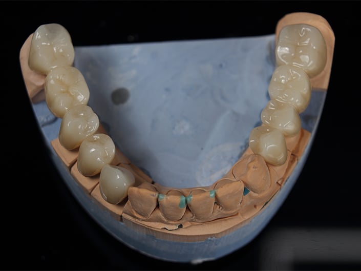 Full-Arch Mandibular Restoration