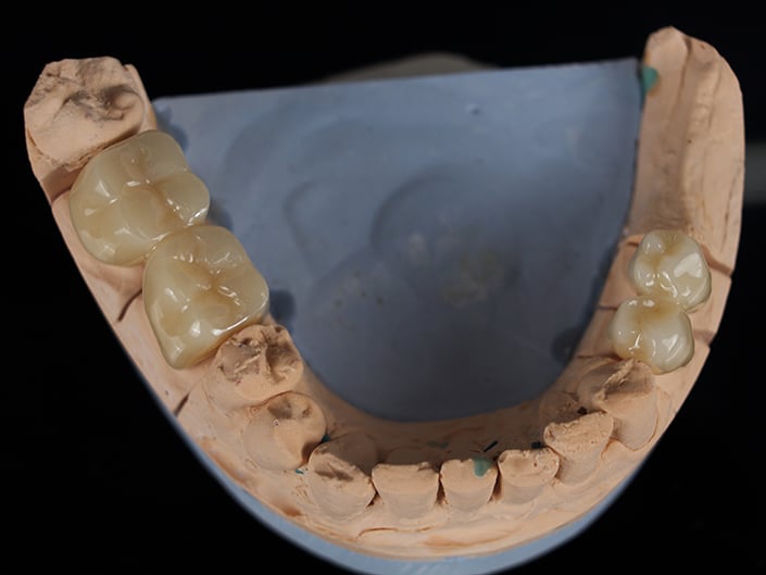 Bilateral Posterior Zirconia Bridge Case