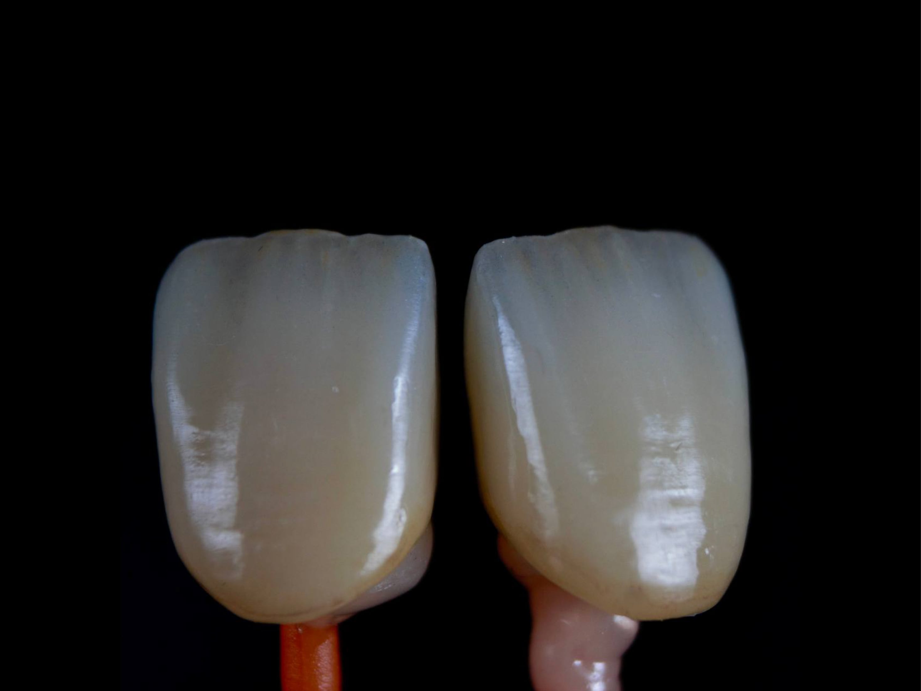 Implant Crown Restoration — Precision Aesthetics at the Incisal Edge