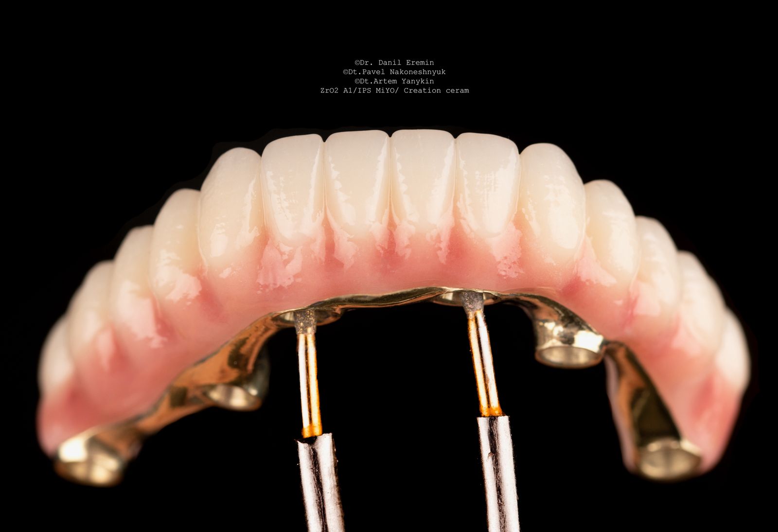 Unmatched Strength and Aesthetics in Ceramic Zirconia Bridges