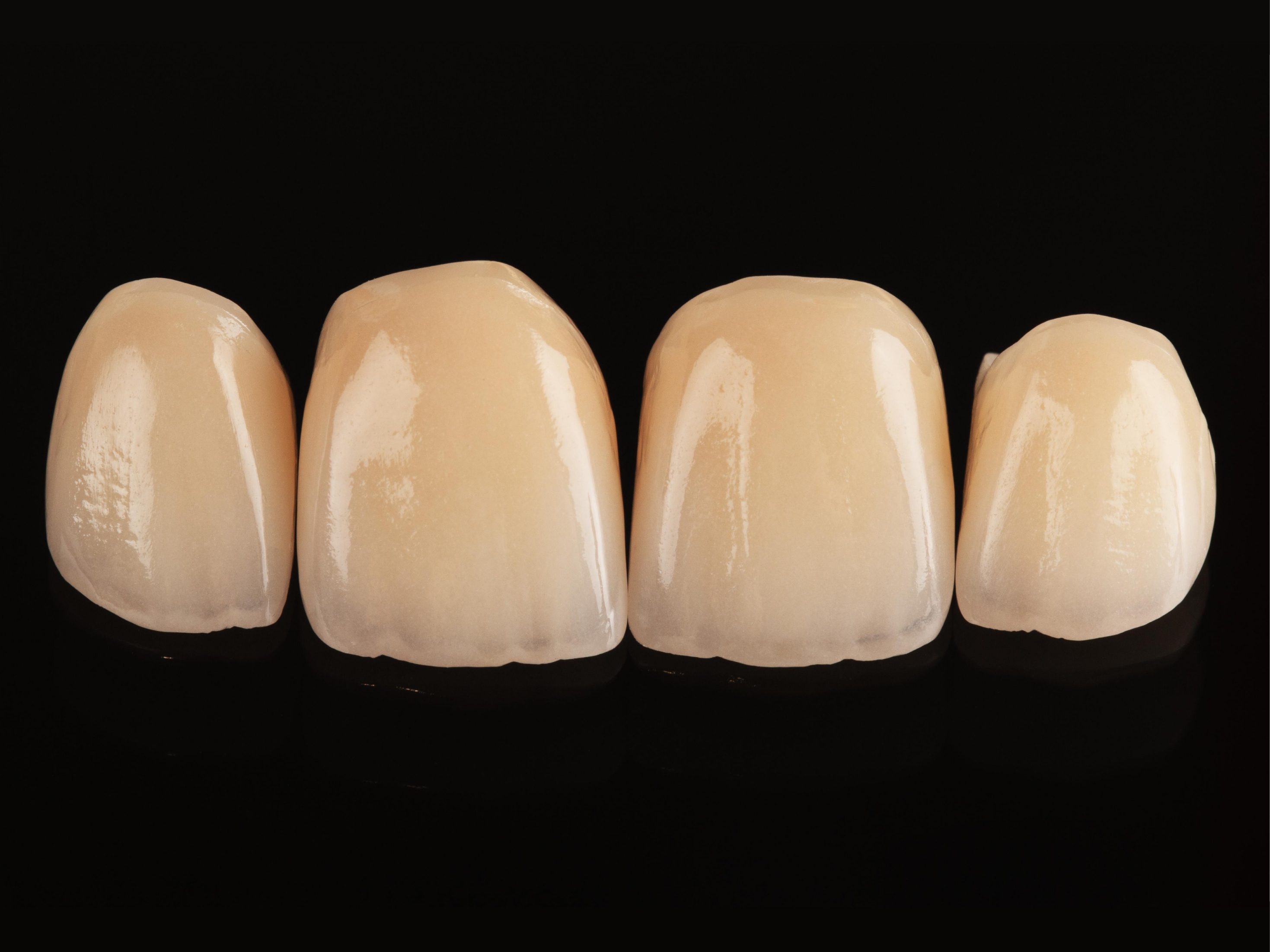 Anterior Full-Ceramic Crown Restoration