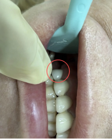 When Zirconia Comes Out Too White: A Manufacturer's Perspective