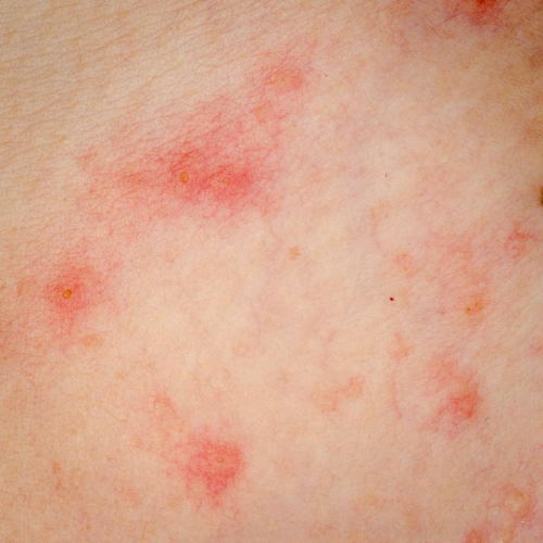 Rapid Anti-Inflammatory Action