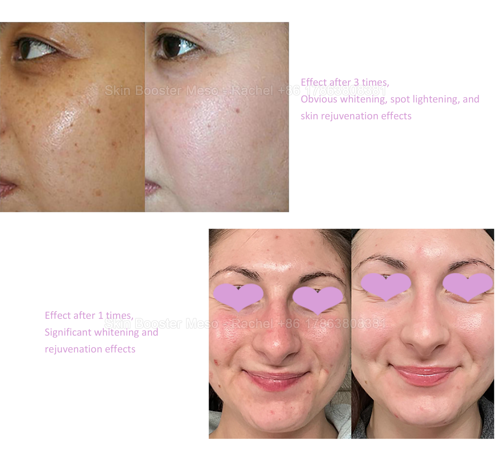 skin-booster---PSD_04.jpg