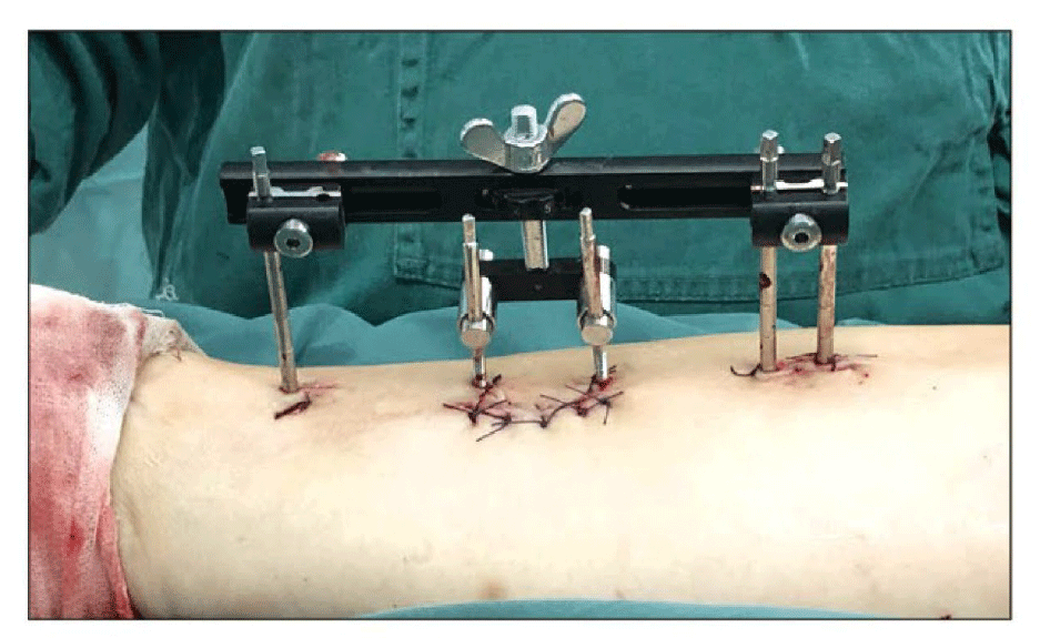 Wishbone-Transverse-Bone-Transport-System_07.png