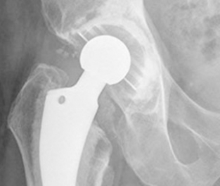 2-Total-Hip-Replacement-2.png