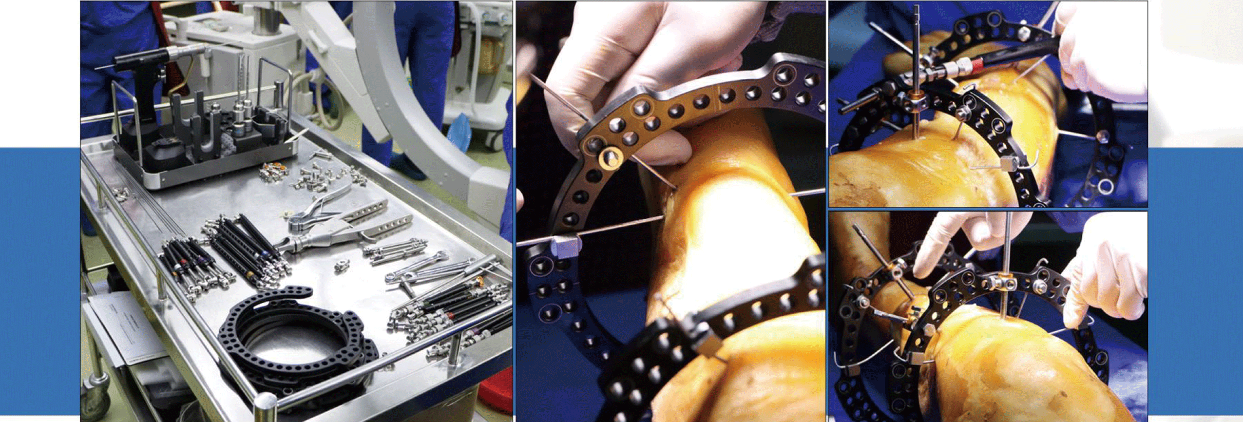 Hexapod-Digital-External-Fixation-Frame_06.png