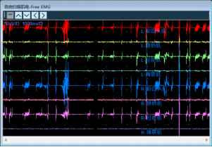 Intraoperative Neurophysiological Monitoring During UBE Surgery for Thoracic Ossification of the Ligamentum Flavum