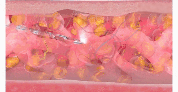 Hyperbaric Oxygen Promotes Rapid Recovery After Plastic Surgery.