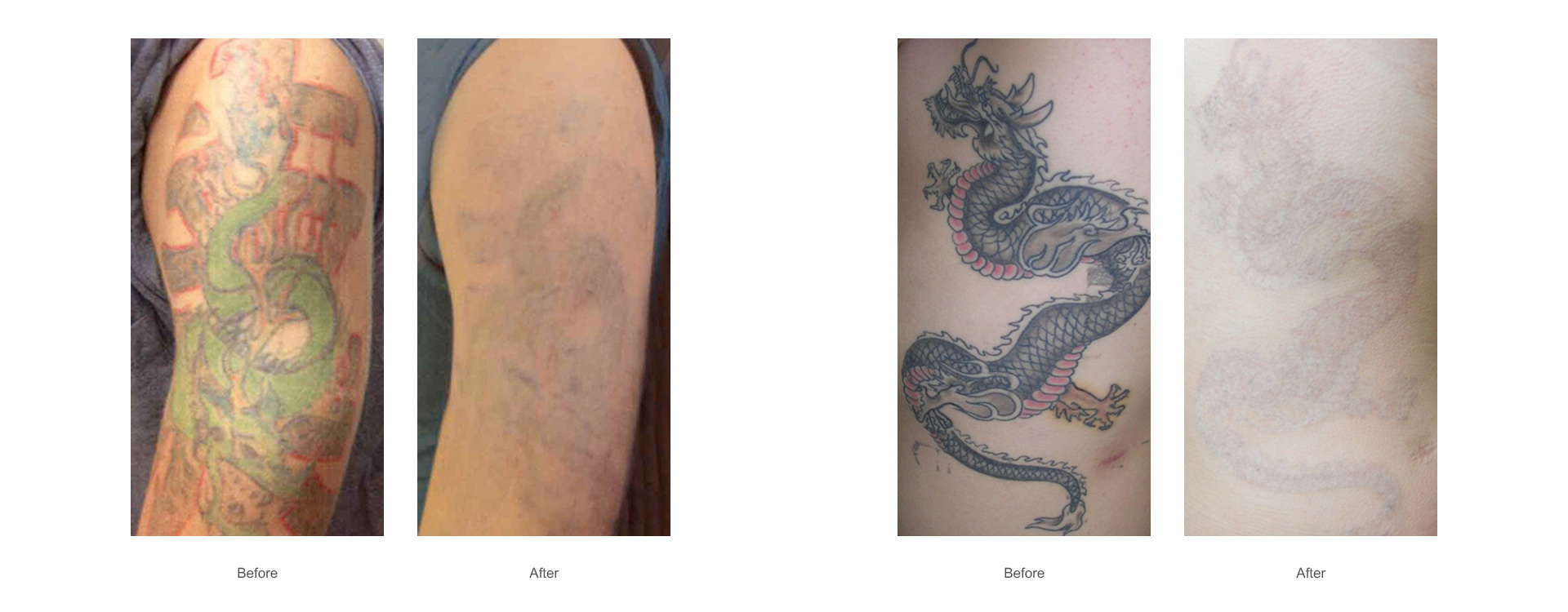 tattoo removal-1