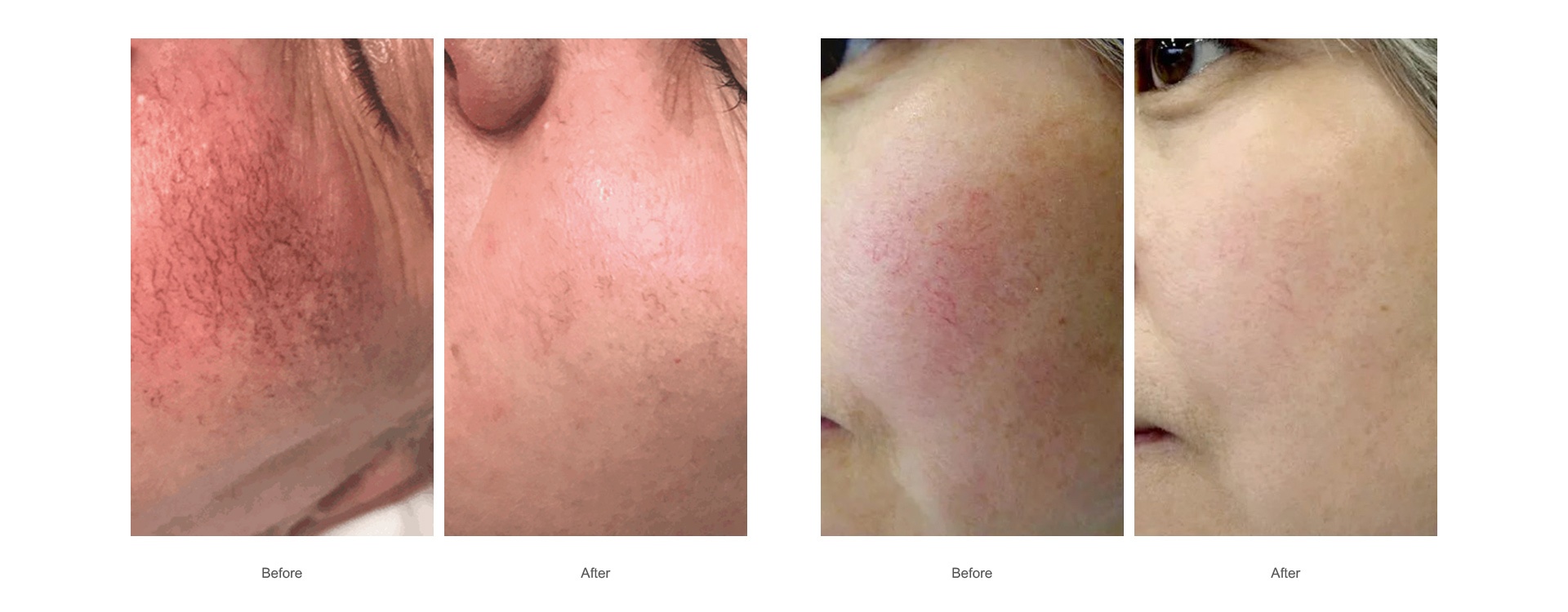 vascular lesions-1