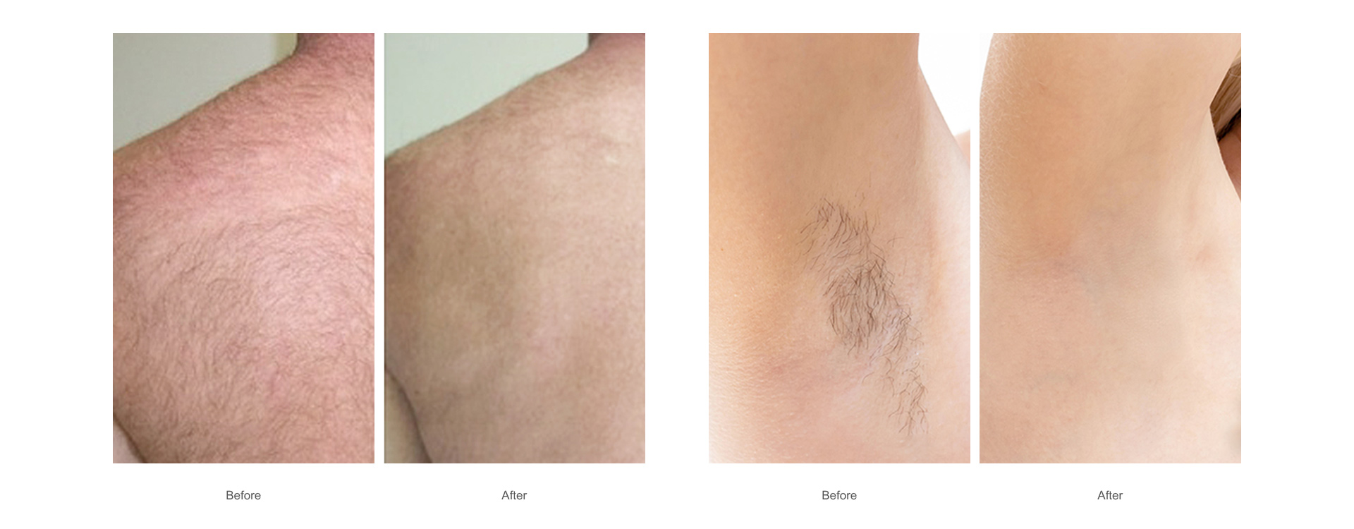 hair removal-1
