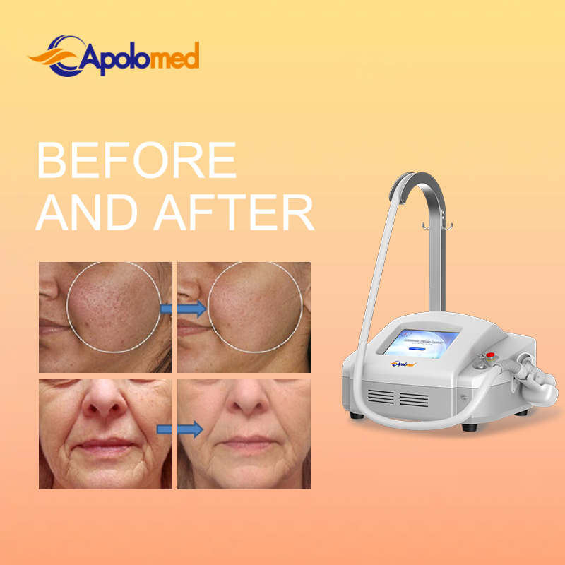 Advanced Erbium Glass Laser Solutions for Aesthetic Medicine