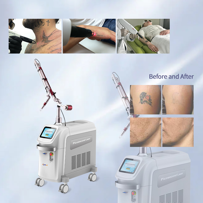 Discover the Benefits of Picosecond Laser Treatment