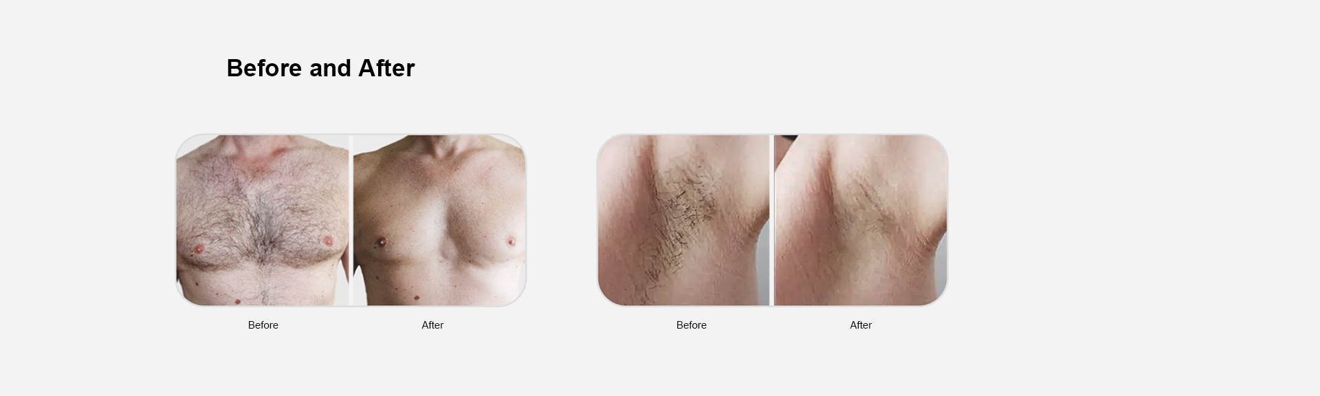Triplewave Diode Laser Hair Removal Device factory