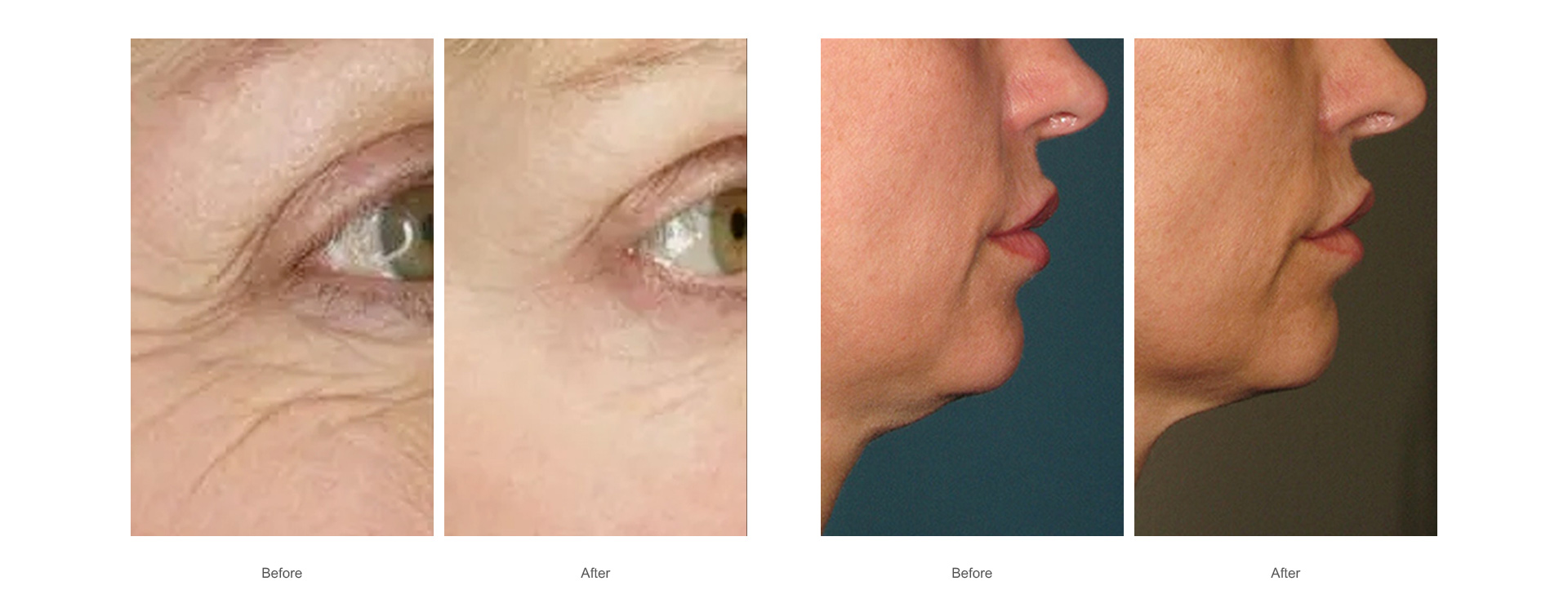 skin tightening lifting-1