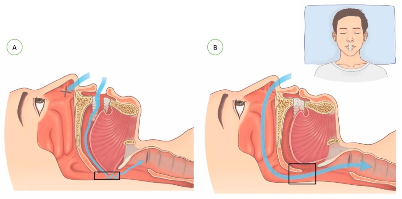 mouth tape for sleep apnea does it really work-1