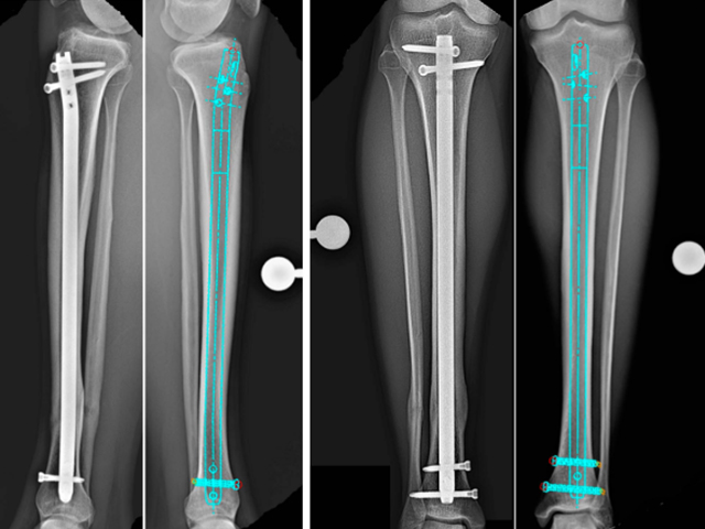 【Surgical Lecture】Tibial Intramedullary Nailing (IMN) Standardized Operating Guide: From Approach Selection to Pitfall Avoidance