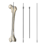 The advantages of using extendable intramedullary needles in pediatric orthopedics