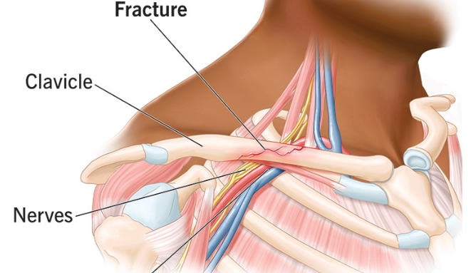 Two Internal Fixation Methods for Clavicle Fractures: Techniques, Tips, and Pitfalls