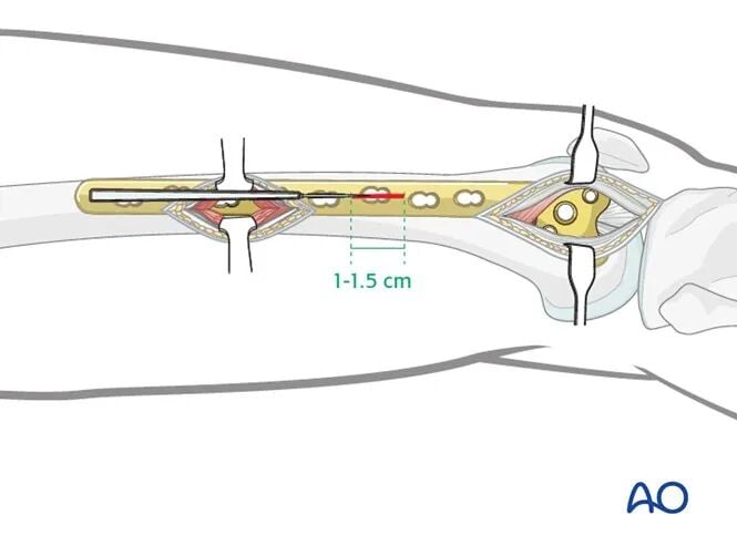 Minimally Invasive Lateral/Anterolateral MIPO Approach to the Distal Femur