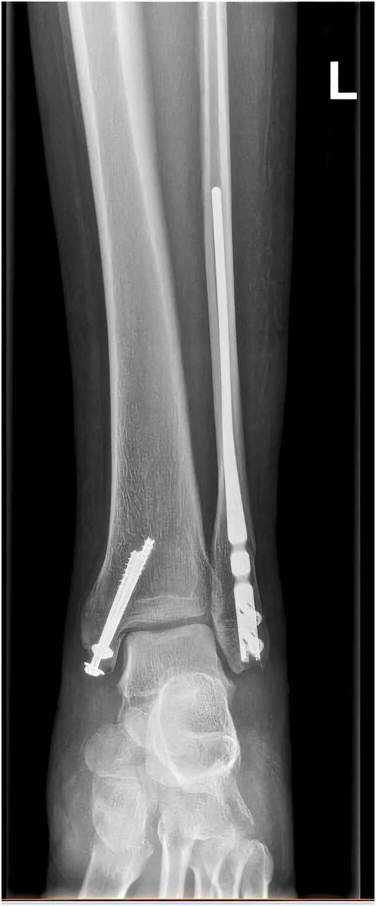 Innovative approach to intramedullary nailing of the fibula: atechnical note