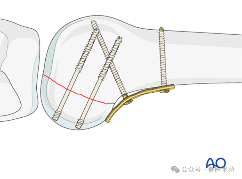 Open Reduction and Internal Fixation of Hoffa Fracture with Plate and Screws