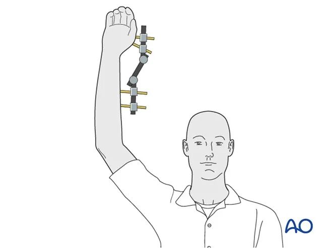 Transarticular External Fixation for Distal Radius Fractures
