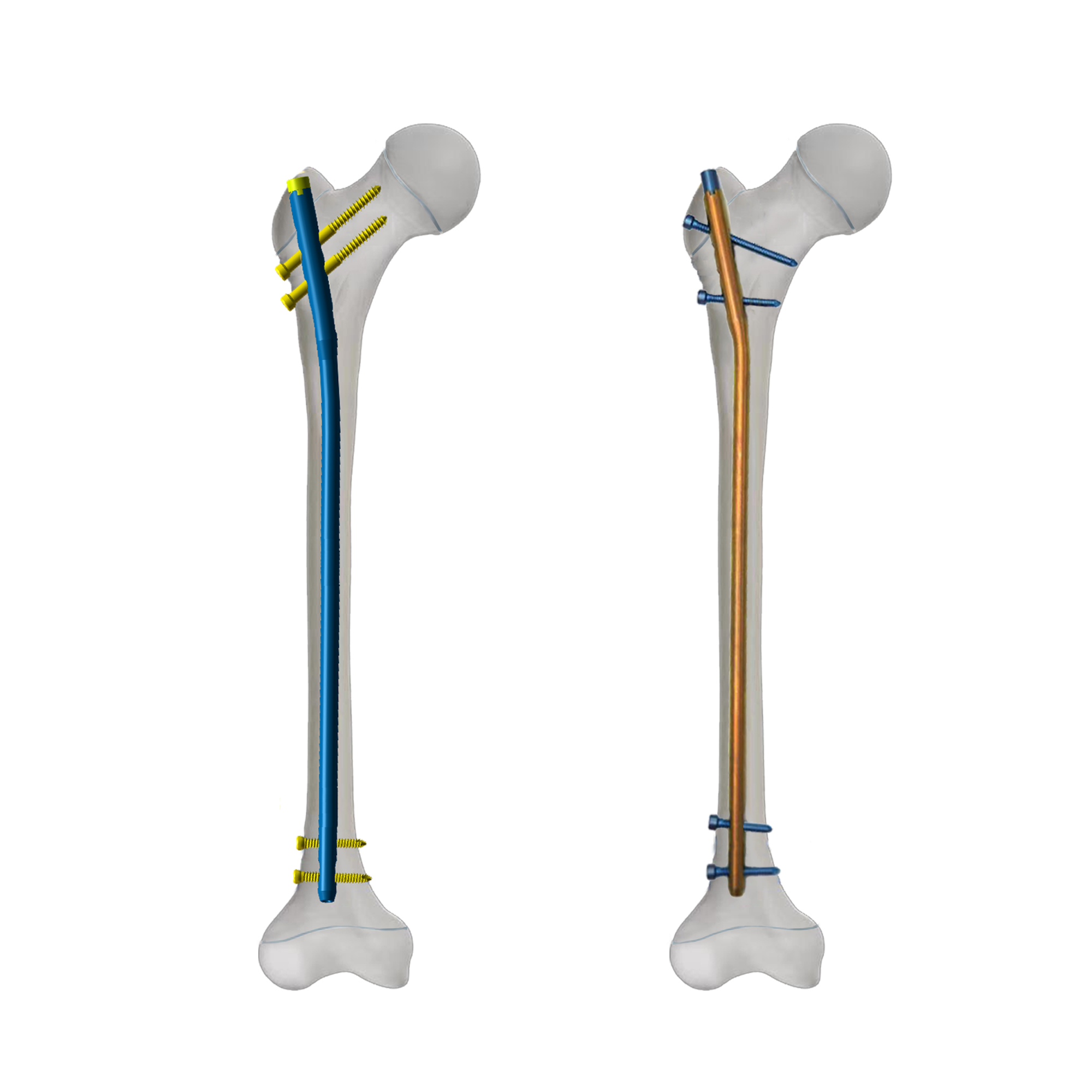 What is the growth trend of the pediatric orthopedic implant market? What is the future development outlook?