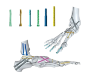 Why Surgeons Prefer Cannulated Screw Fixation Methods